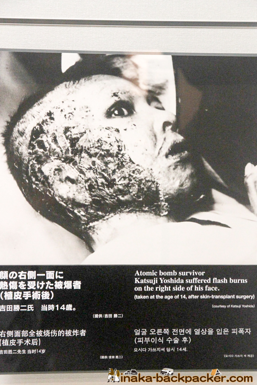 Nagasaki Atomic Bomb Museum – Mr. Katsuji Yoshida suffered burns on the right side of his face